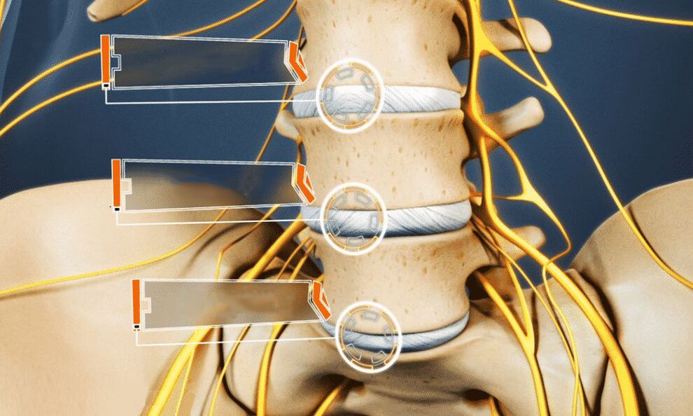 hernia intervertebral leva á impotencia